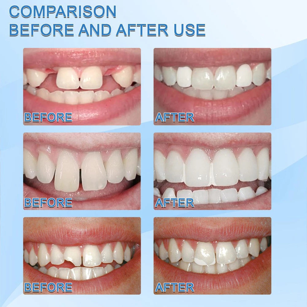 SMS Moldable Denture Gum Temporary Filling Restoration