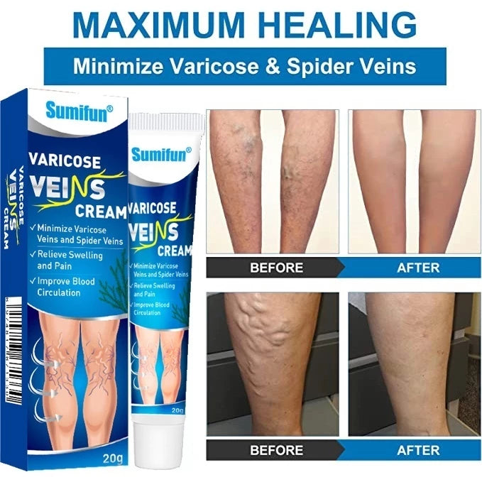 Sumifun Varicose Veins Cream Varicose Veins Remover 20g