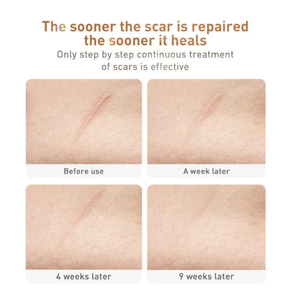 Sunisa Whitening And Scar Removal Cream 20g