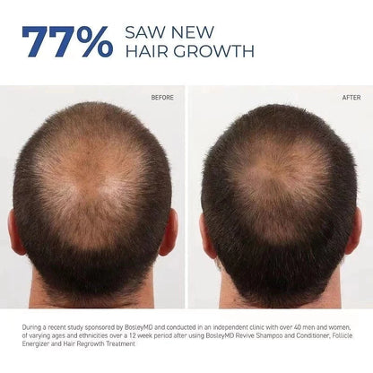 Minoxidil Strands Hair Regrowth Treatment